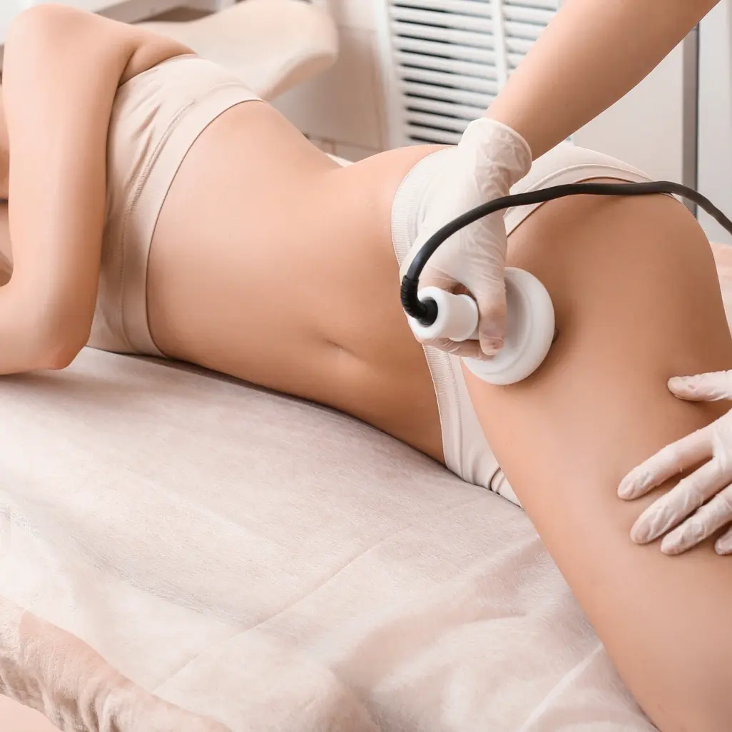 radiofrequence-cellulite-marseille